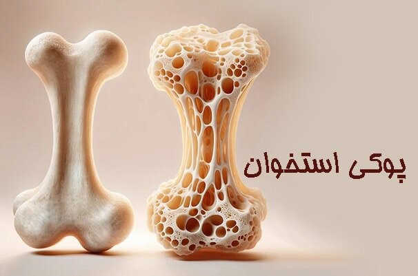 توصیه های پزشکان/ بهترین ویتامین ها برای پیشگری از پوکی استخوان