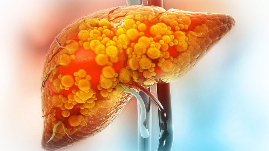 علائم اصلی بیماری کبد چرب